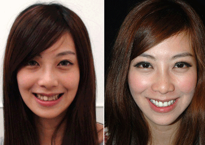 成人整牙攻略视频,揭秘整牙全过程与注意事项