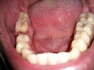 成人龋齿怎么自愈视频